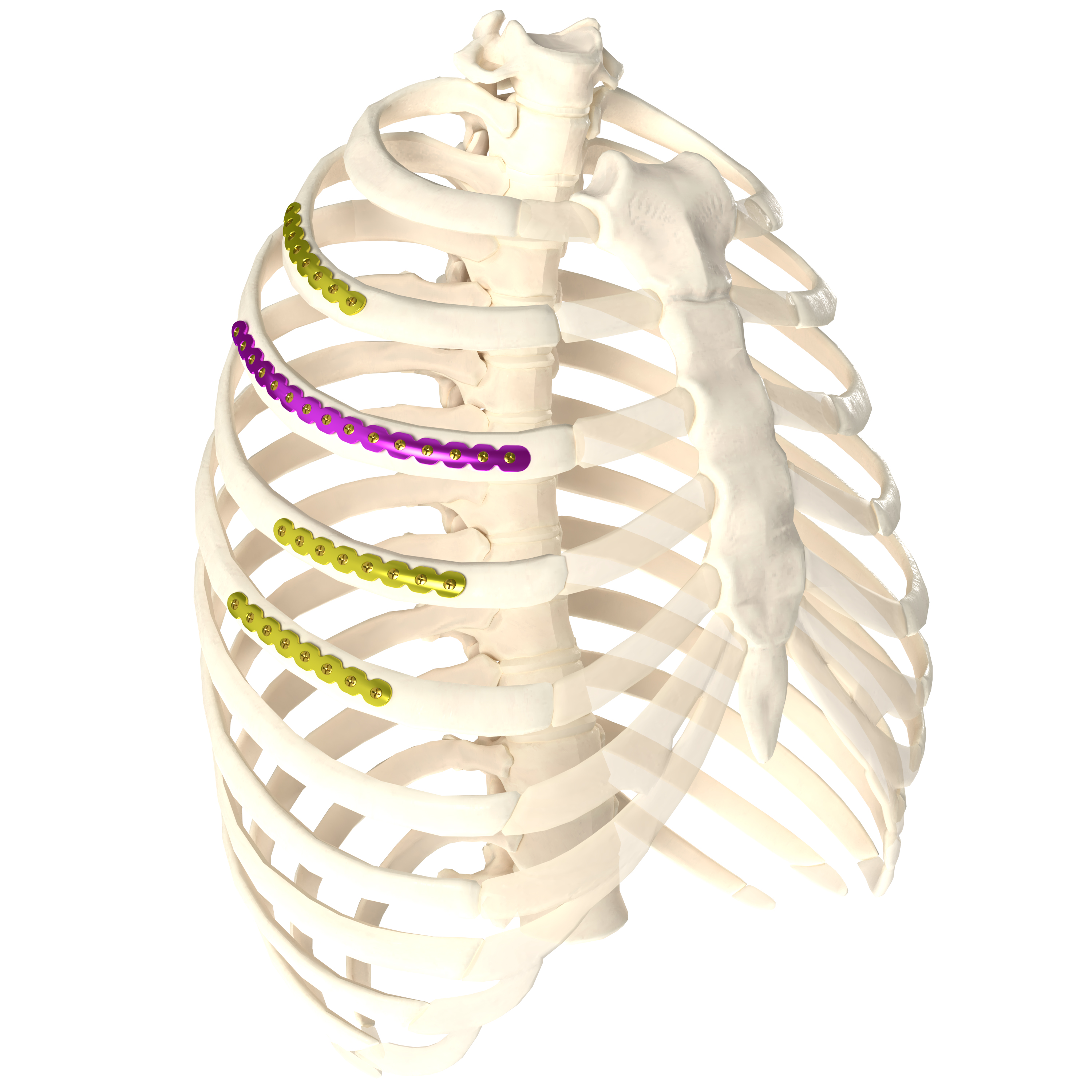 肋骨接骨板系統(tǒng)